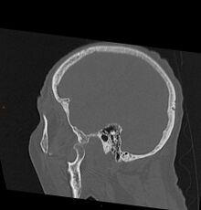 CT image demonstrating jaw dislocation