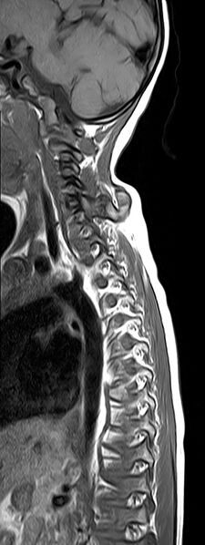 File:Bilateral Sprengel deformity with Klippel-Feil syndrome (Radiopaedia 66395-75650 Sagittal T1 9).jpg