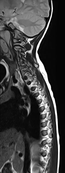 File:Bilateral Sprengel deformity with Klippel-Feil syndrome (Radiopaedia 66395-75650 Sagittal T2 3).jpg