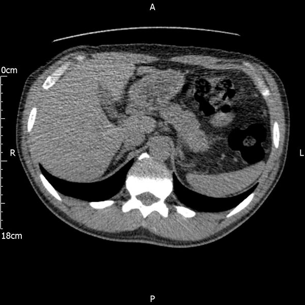 File:Bilateral medullary nephrocalcinosis with ureteric calculi (Radiopaedia 71269-81569 Axial non-contrast 22).jpg