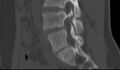 Bilateral pars defect (Radiopaedia 26691-26846 Sagittal bone window 38).jpg