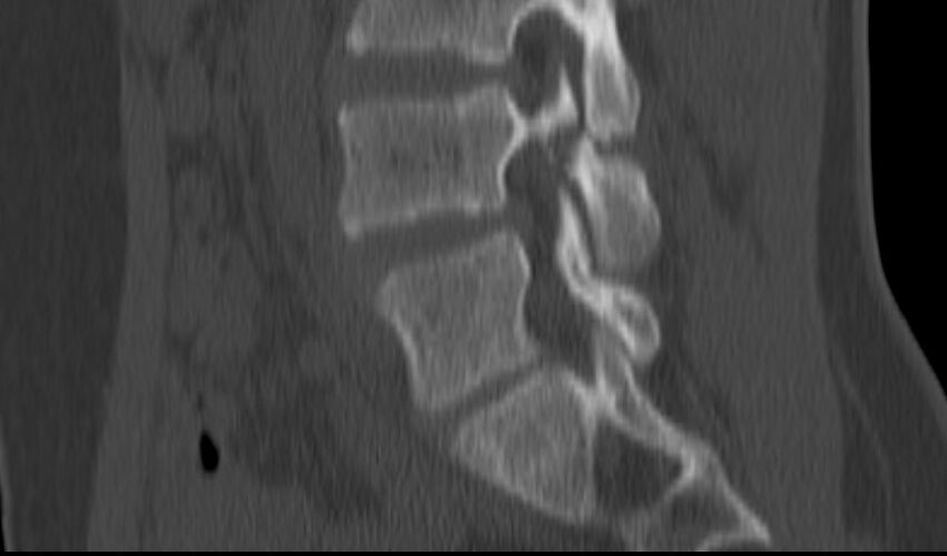 Bilateral pars defect (Radiopaedia 26691-26846 Sagittal bone window 38).jpg