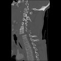 Bilateral perched facets with cord injury (Radiopaedia 45587-49713 Sagittal bone window 31).jpg
