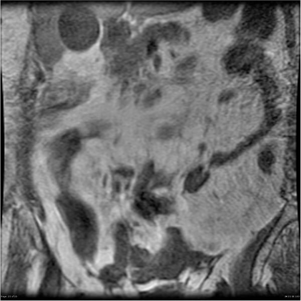 File:Bilateral psoas hematomas (Radiopaedia 24057-24280 B 21).jpg