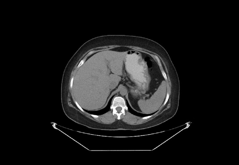 File:Bilateral urolithiasis with incidentally detected splenic artery aneurysm and left inferior vena cava (Radiopaedia 44467-48123 Axial non-contrast 8).jpg