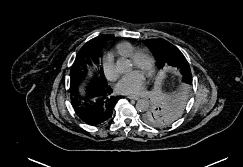 Biliary pancreatitis (Radiopaedia 72289-82823 Axial non-contrast 10).jpg