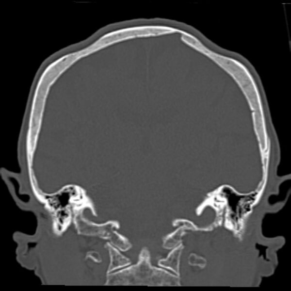 File:Biparietal osteodystrophy (Radiopaedia 46109-50463 Coronal bone window 64).jpg