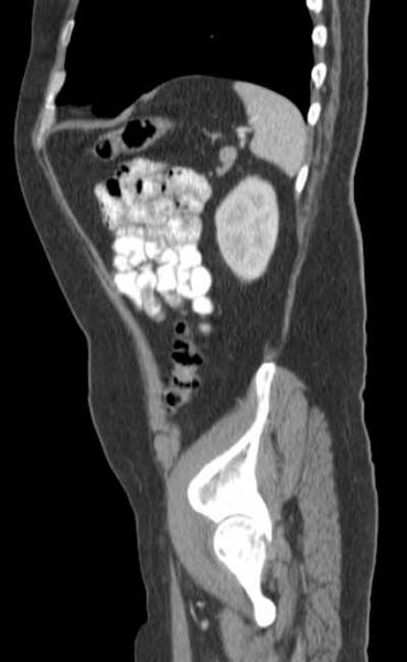 File:Bleeding duodenal ulcer and adenomyomatosis of gallbladder (Radiopaedia 61834-69861 C 83).jpg