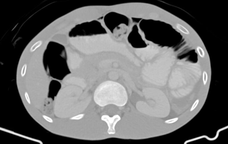 File:Blunt injury to the small bowel (Radiopaedia 74953-85987 Axial Wide 26).jpg