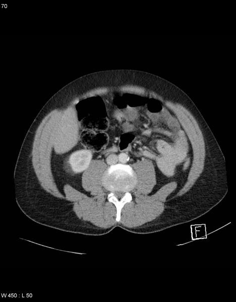 File:Boerhaave syndrome with tension pneumothorax (Radiopaedia 56794-63603 A 35).jpg