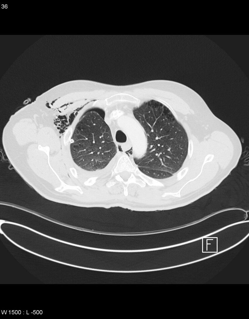 Boerhaave syndrome with tension pneumothorax (Radiopaedia 56794-63605 Axial lung window 17).jpg