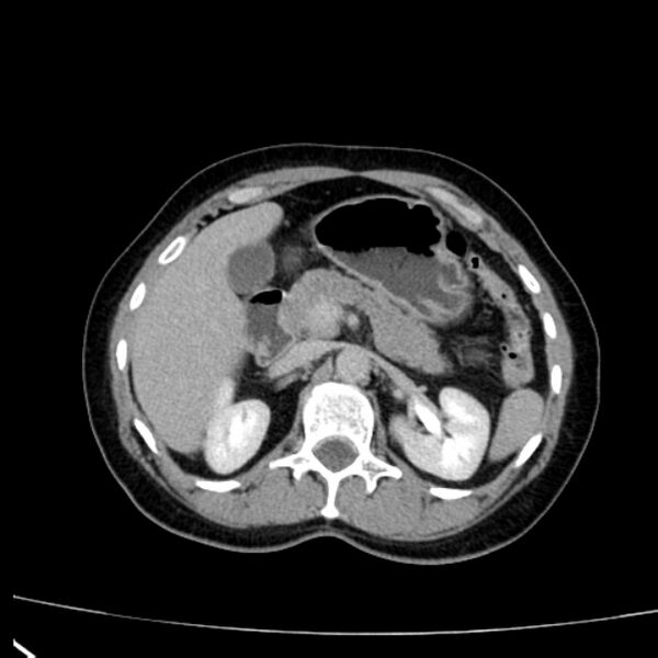 File:Bosniak renal cyst - type I (Radiopaedia 27479-27675 D 11).jpg