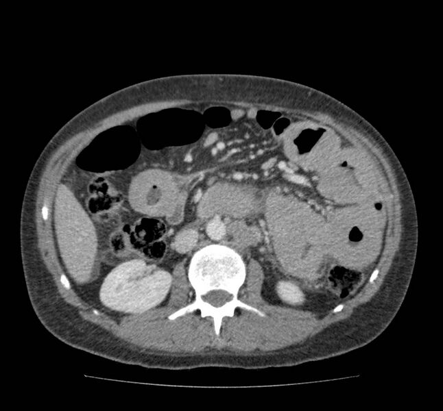 File:Bowel lymphoma complicated by bleeding after therapy (Radiopaedia 55601-62107 A 38).jpg