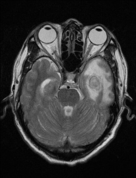 File:Brain abscess with ventriculitis (Radiopaedia 85703-101495 Axial T2 8).jpg