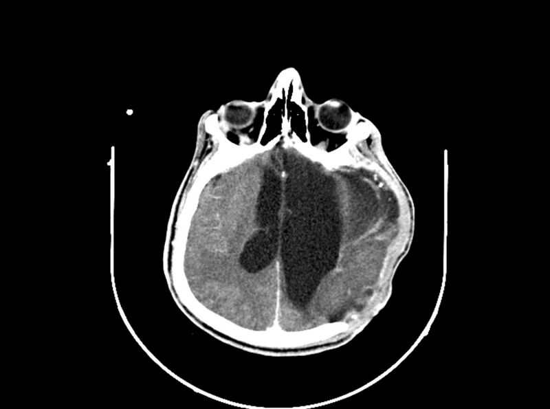 File:Brain injury by firearm projectile (Radiopaedia 82068-96088 B 135).jpg