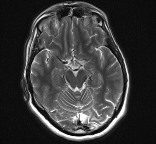 File:Brain metastases - lung cancer primary (Radiopaedia 75060-86115 Axial T2 11).jpg