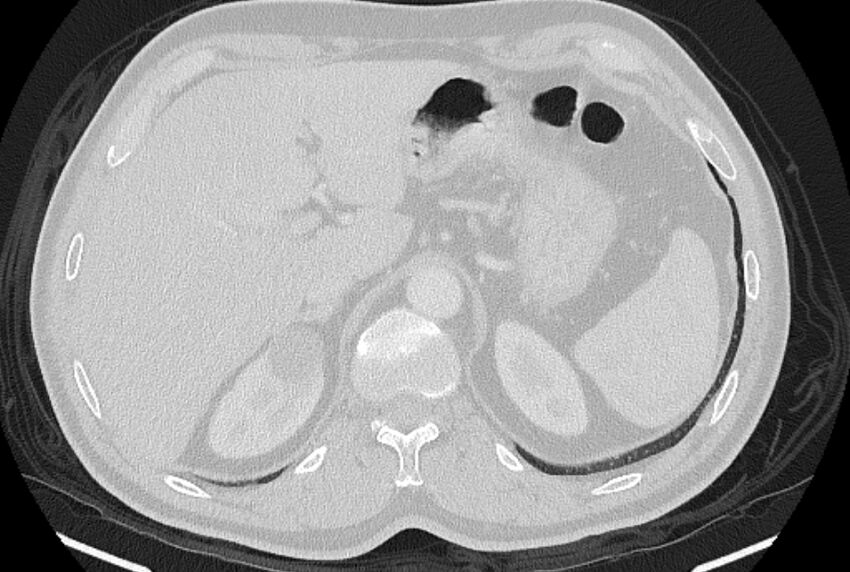Brain metastases - lung cancer primary (Radiopaedia 75060-86116 Axial lung window 59).jpg