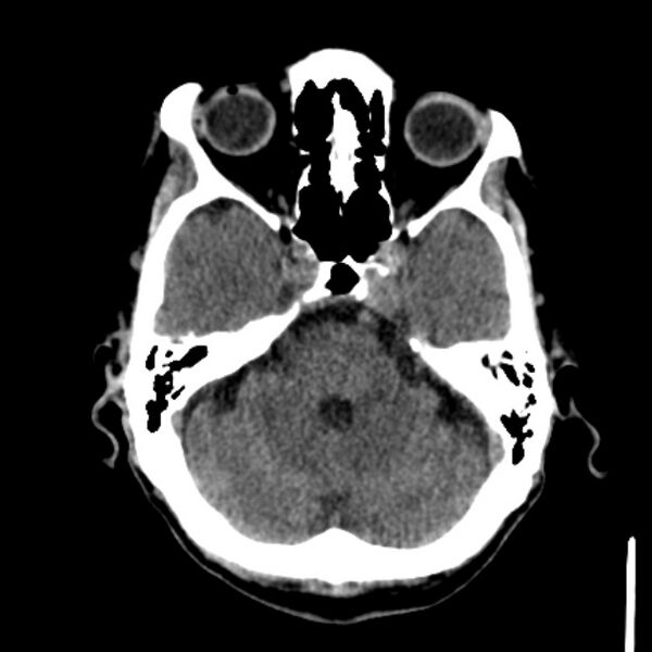 File:Brain metastases from lung cancer (Radiopaedia 27849-28092 Axial non-contrast 14).jpg