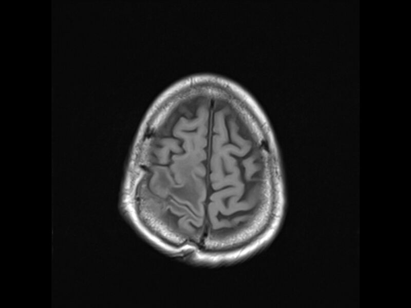 File:Brain metastases from renal cell carcinoma (Radiopaedia 42222-45297 Axial T1 22).jpg