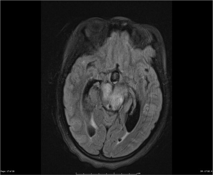 File:Brainstem glioma (Radiopaedia 21819-21775 Axial FLAIR 17).jpg