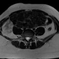 Broad ligament fibroid (Radiopaedia 49135-54241 Axial T2 6).jpg
