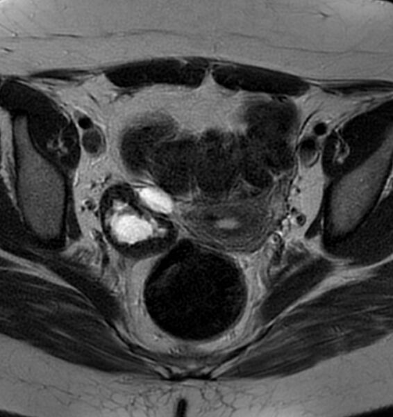 File:Broad ligament leiomyoma (Radiopaedia 81634-95516 Axial T2 13).jpg