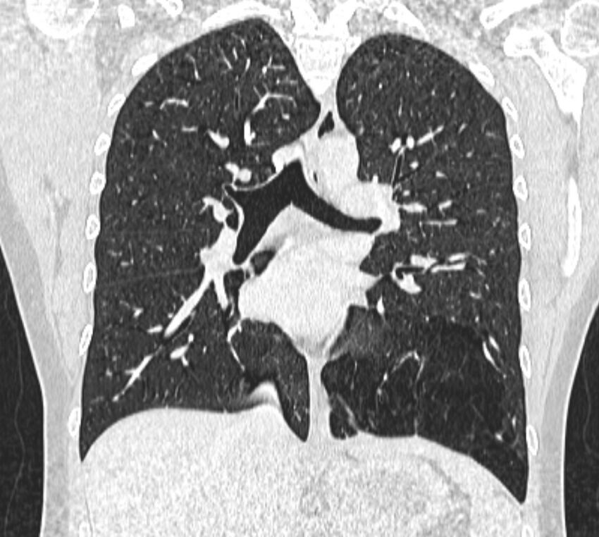 Bronchial atresia (Radiopaedia 50007-55297 Coronal lung window 59).jpg