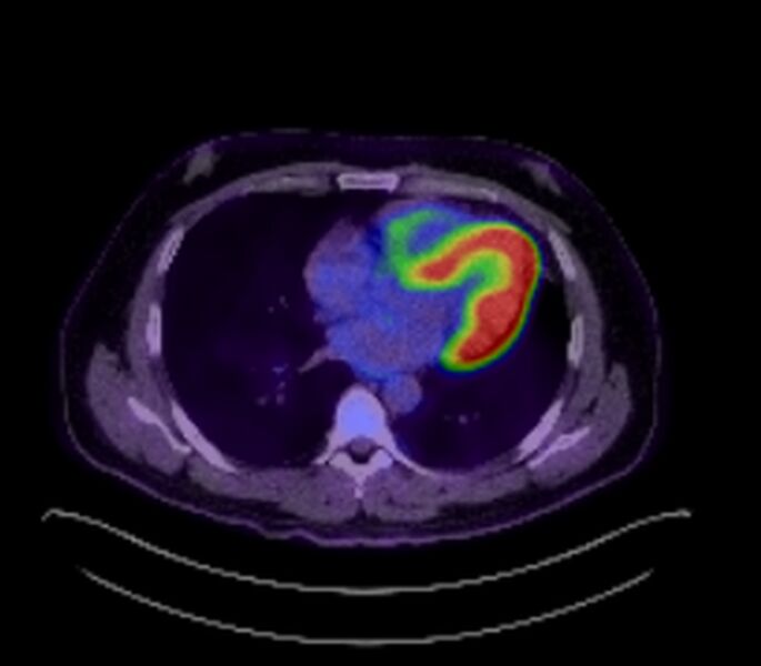 File:Bronchial carcinoid tumor (Radiopaedia 67377-76766 18FDG-PET-CT 30).jpg