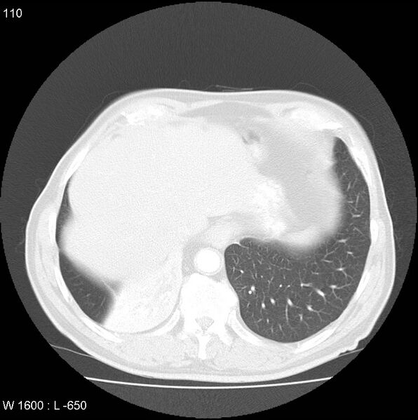 File:Bronchial carcinoid tumor with right lower lobe collapse (Radiopaedia 29060-29422 B 48).jpg
