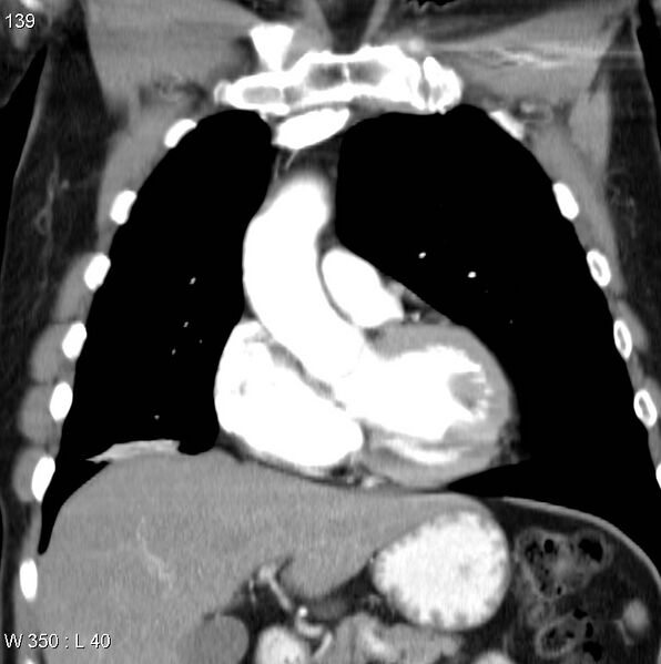 File:Bronchial carcinoid tumor with right lower lobe collapse (Radiopaedia 29060-29422 C 8).jpg
