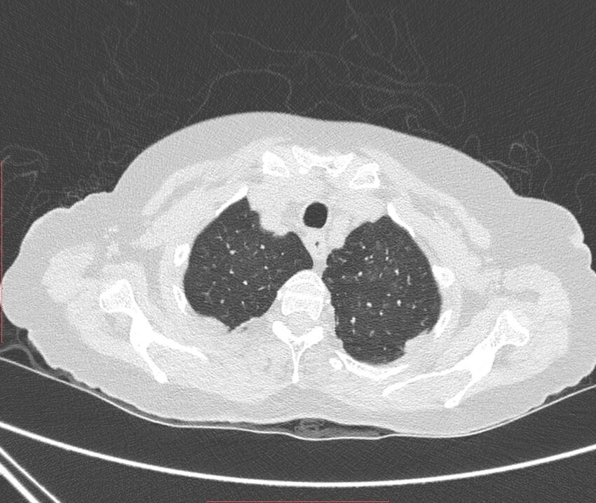 Bronchiectasis (Radiopaedia 72693-83293 Axial lung window 13).jpg
