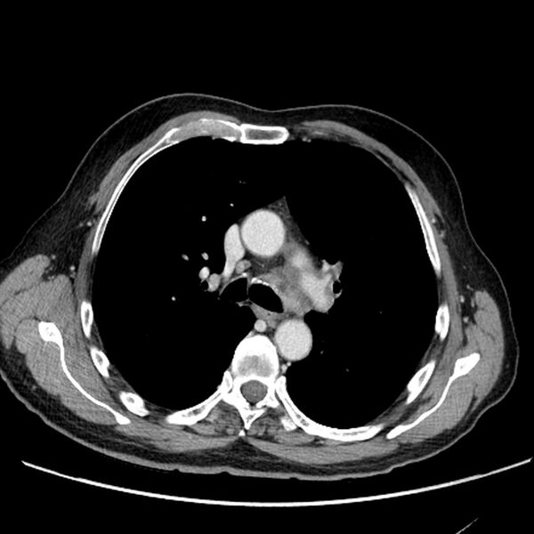 File:Bronchogenic carcinoma with L1 vertebra metastasis (Radiopaedia 9096-9805 Axial C+ delayed 12).jpg
