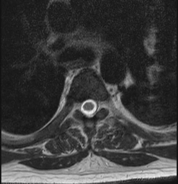 File:Brown tumors compressing the spinal cord (Radiopaedia 68442-78030 A 38).jpg
