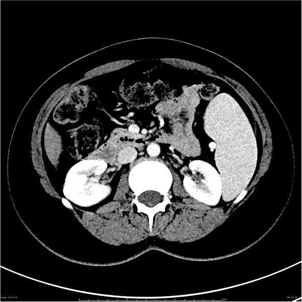 File:Budd-Chiari syndrome (Radiopaedia 27929-28177 Axial liver window 30).JPG