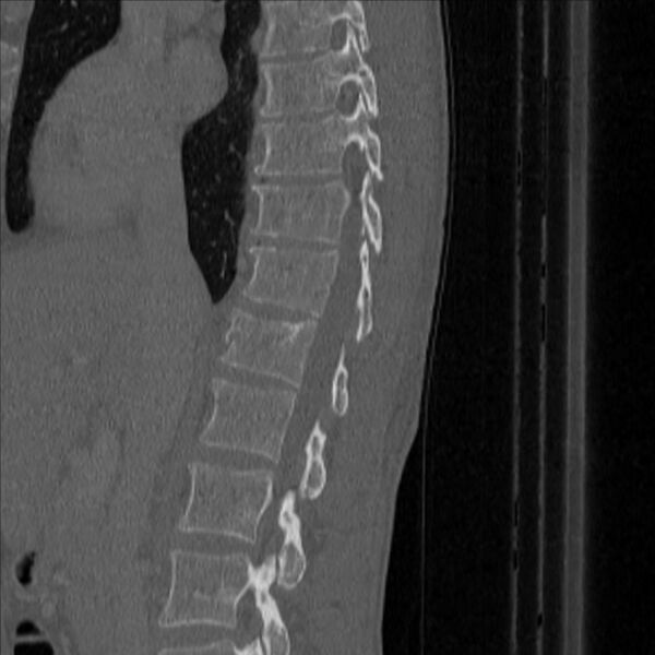 File:Bulging of paraspinal line in traumatic thoracal spinal compression fracture (Radiopaedia 29221-35872 Sagittal bone window 17).jpg