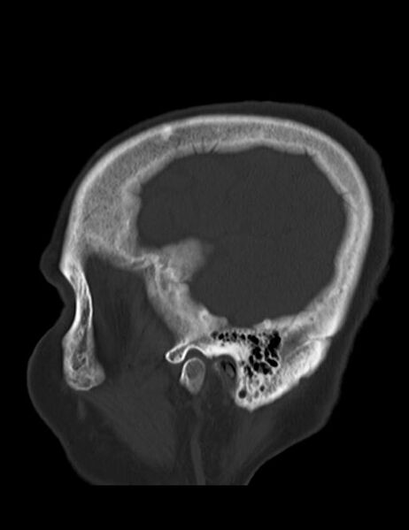 File:Burnt-out meningioma (Radiopaedia 51557-57337 Sagittal bone window 39).jpg