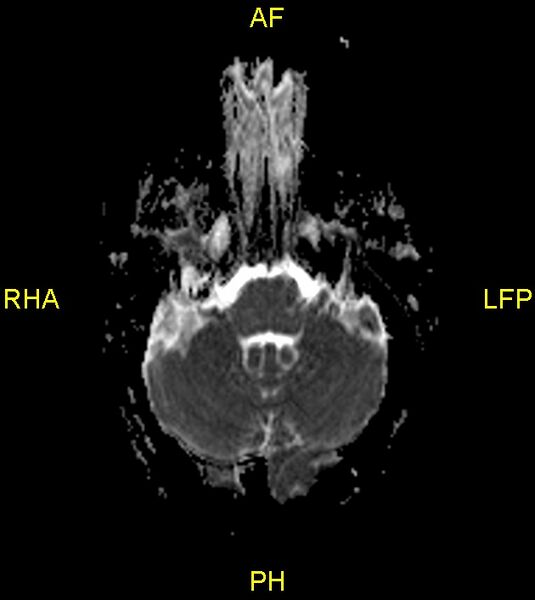 File:Butterfly glioma (Radiopaedia 76707-88526 Axial ADC 6).jpg
