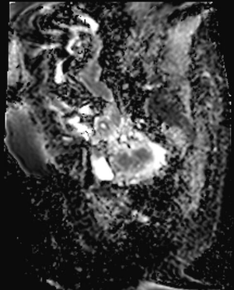 File:Cancer cervix - stage IIb (Radiopaedia 75411-86615 Sagittal ADC 6).jpg