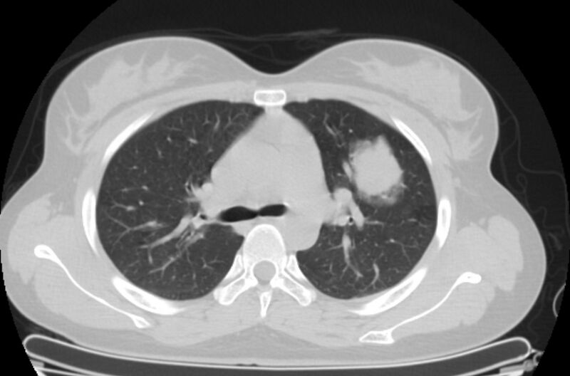 File:Cannonball metastases - uterine choriocarcinoma (Radiopaedia 70137-80173 Axial lung window 29).jpg