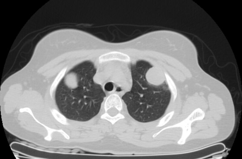 File:Cannonball metastases - uterine choriocarcinoma (Radiopaedia 70137-80173 Axial lung window 9).jpg