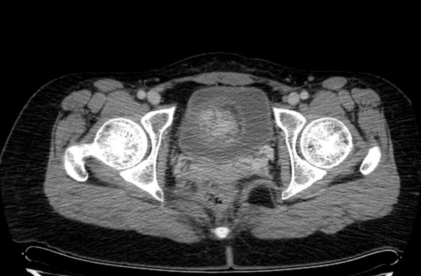 Cannonball metastases - uterine choriocarcinoma (Radiopaedia 70137-80174 A 50).jpg