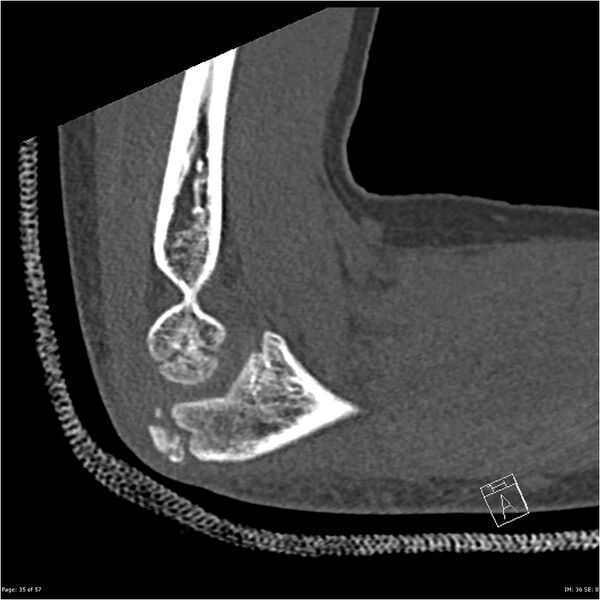 File:Capitellum fracture (Radiopaedia 23352-23426 Sagittal bone window 35).jpg