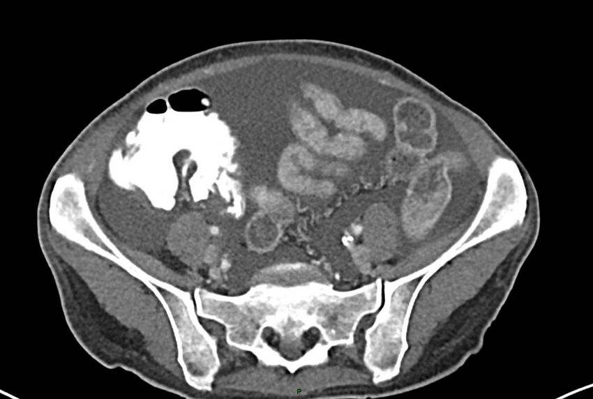 Carcinoid mesenteric tumor complicated by chylous ascites (Radiopaedia 76312-87953 A 55).jpg