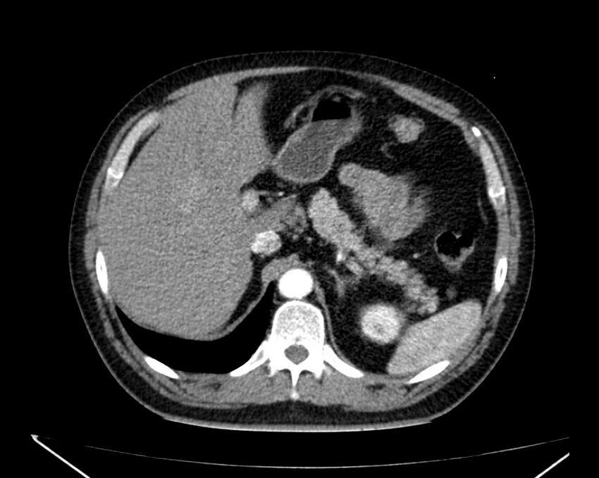 Carcinoid tumor with hepatic metastases (Radiopaedia 22651-22670 B 23).jpg