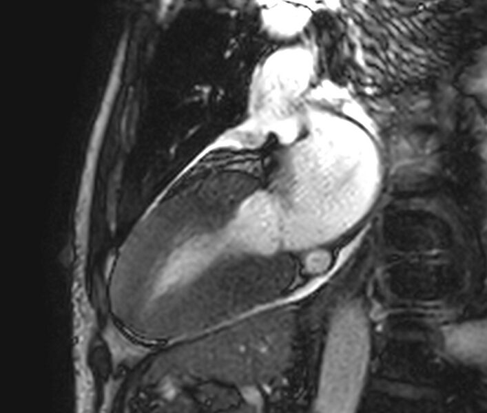 File:Cardiac amyloidosis (Radiopaedia 39736-42124 B 7).jpg