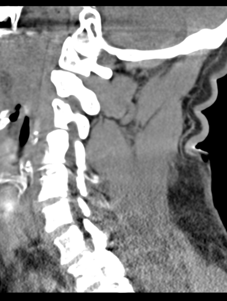 File:Cavernoma of cervical cord (Radiopaedia 50838-56346 B 50).png
