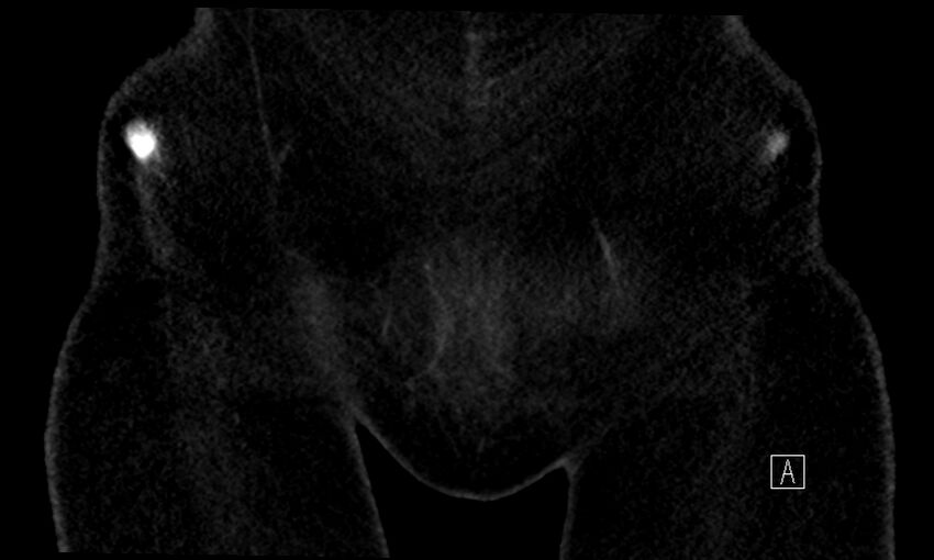 Cecoureterocele containing a calculus (Radiopaedia 80346-93731 Coronal Cystogram 1).jpg
