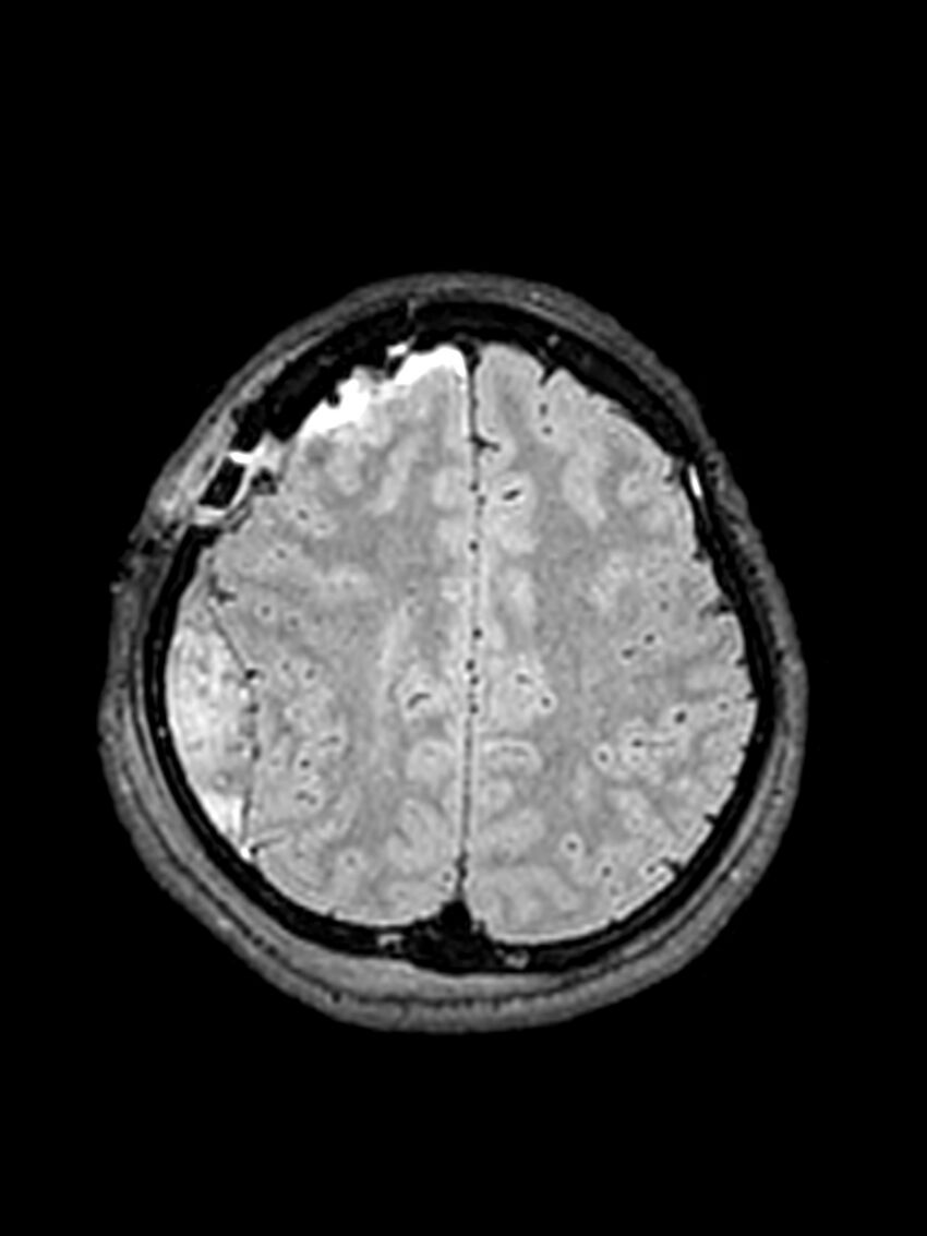 Central neurocytoma (Radiopaedia 79320-92381 Axial FLAIR 53).jpg