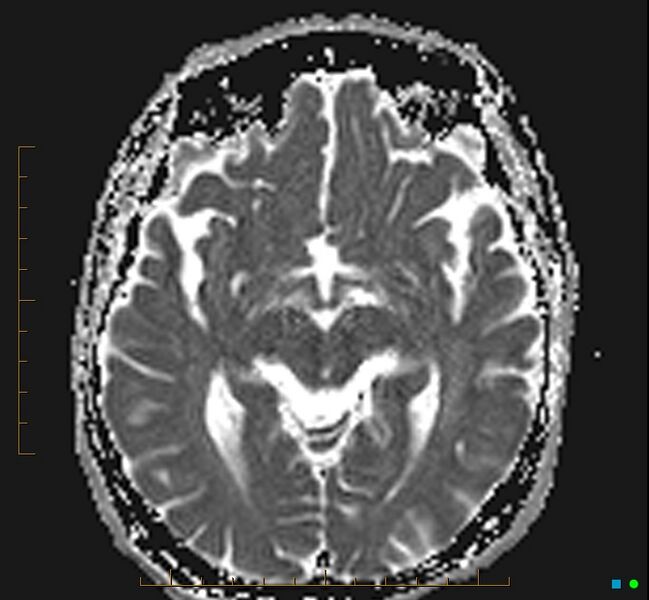 File:Cerebellar gangliocytoma (Radiopaedia 65377-74422 Axial ADC 17).jpg