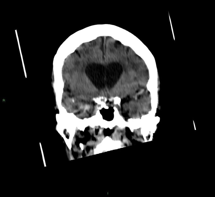 Cerebellar hemorrhage (Radiopaedia 58792-66026 Coronal non-contrast 41).jpg